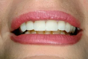 Smile gallery case 1 - After