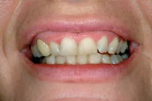Smile gallery case 1 - Before