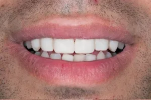 Smile gallery case 2 - After