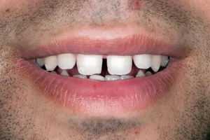 Smile gallery case 2 - Before