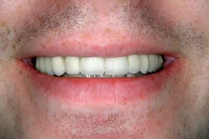 Smile gallery case 3 - After