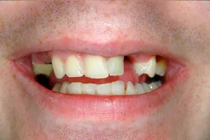 Smile gallery case 3 - Before