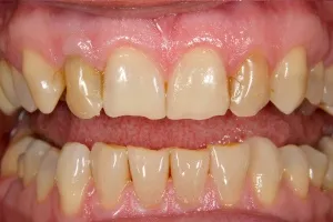 Smile gallery case 4 - Before