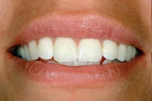 Smile gallery case 6 - After