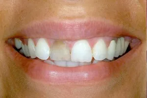 Smile gallery case 6 - Before