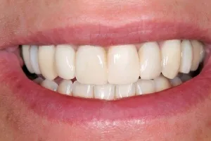 Smile gallery case 7 - After
