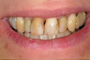 Smile gallery case 7 - Before